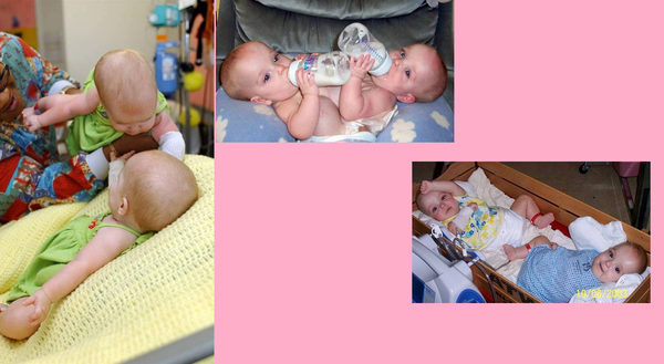 L'incroyable histoire de triplées dont 2 nées siamoises !