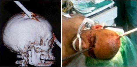 Un Brésilien survit malgré une barre dans le crâne.
