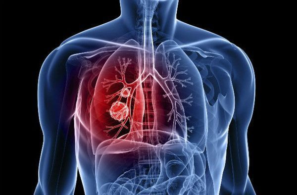 Dépister le cancer du poumon