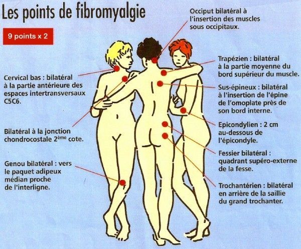 fibromyalgie