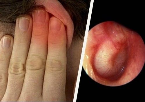 le cérumen dans l’oreille